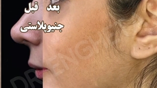 فیلم قبل و بعد از جراحی جنیوپلاستی یا جراحی چانه