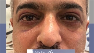 بلفاروپلاستی پلک فوقانی و تحتانی در آقایان