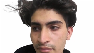 عمل بینی مردانه