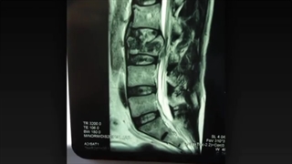 L3 burst fracture