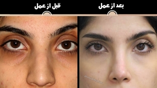 عمل زیبایی بینی | دکتر امید ابراهیمی