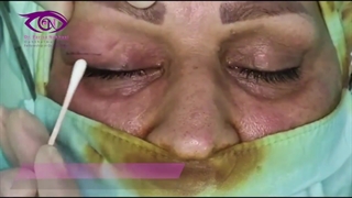 خارج کردن تومور غده چشم