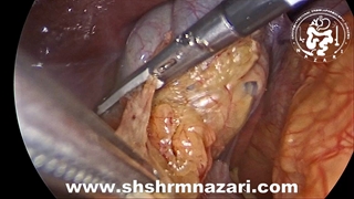 عمل همزمان اسلیو و سنگ کیسه صفرا