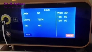 فیلم اندولیفت غبغب