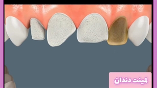 ایا لمینت دندان باعث بوی بد دهان میشود