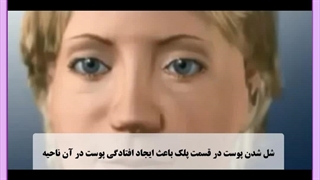 بلفاروپلاستی آقایان