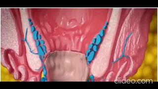 نحوه جراحی و درمان هموروئید بدون درد و خونریزی