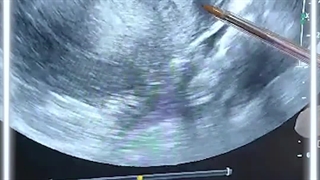 سونوگرافی ترانس رکتال