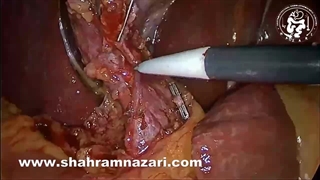 اسفنکترکتومی لاپاروسکوپیک در سنگ کلدوک