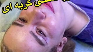 رفع پف پلک در کلینیک آرتین