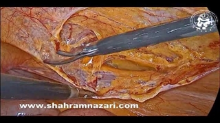 ترمیم لاپاروسکوپی فتق سمت راست