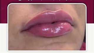 فیلر لب به سبک روسی