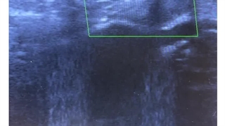 تست اصلی تشخیص واریس( سونوگرافی داپلر وریدی پا )