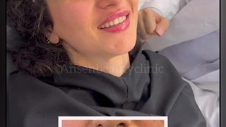 تزریق ژل لب روسی و عروسکی در کرج