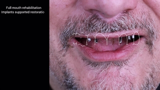 دکتر مرتضی قادری،رضایت بیمار از ایمپلنت