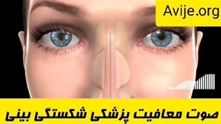 آیین نامه معافیت پزشکی شکستگی و انحراف بینی