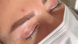 بلفاروپلاستی پلک بالا