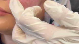 عوارض تزریق فیلر نامرغوب پالپوتومی