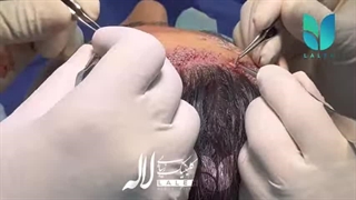 کاشت مو خانوم ها با تراکم بالا در کلینیک لاله
