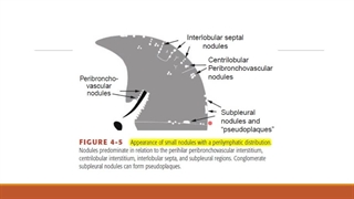 سیتی اسکن ریه