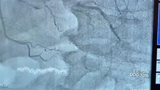 انجام آنژیوپلاستی به جای قلب قلب باز توسط دکتر نجفی