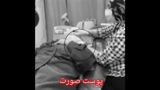 لیفتینگ و جوانسازی پوست با دستگاه پزشکی Aphrodite