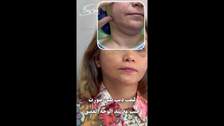 جراحة شد الوجه و تجمیل الجفون