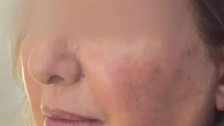معجزه تغییر فیلر لب با یک سی سی تزریق ژل لب