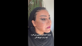 جراحی لیفت صورت و گردن | 20 سال جوانسازی بی قید و شرط