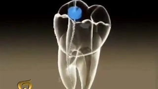 عصب کشی دندان