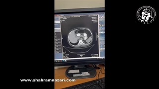 توده‌های آزاد در حفره شکمی