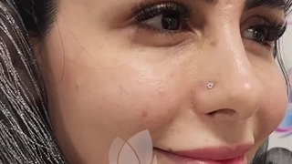 بوتاکس در کلینیک آوینا