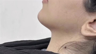 زاویه سازی صورت در کلینیک ماهرخ