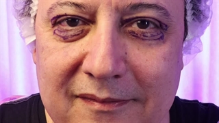 بلفاروپلاستی